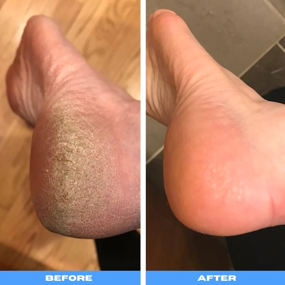 SmoothSteps™ Electric Pedicure Wand